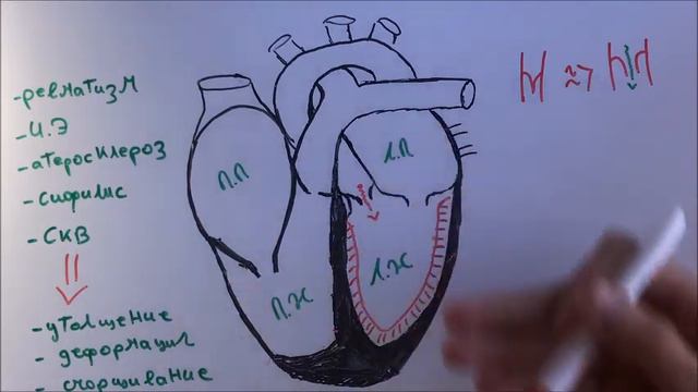 Недостаточность аортального клапана (аортальная недостаточность) смотреть онлайн