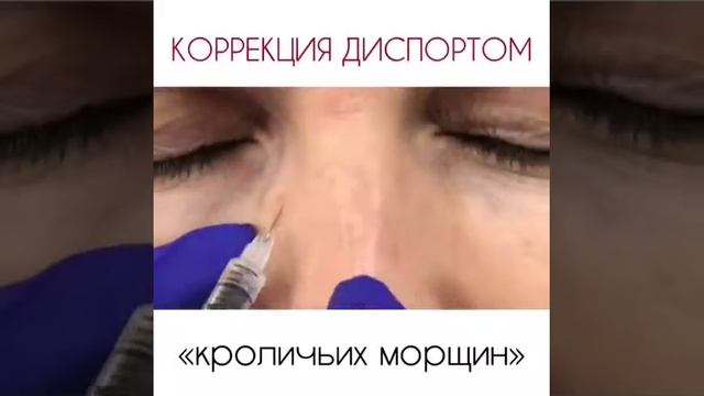 Коррекция «кроличьих морщин» смотреть онлайн