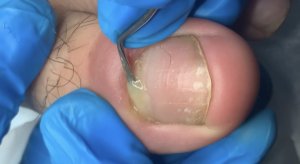 Подногтевой панариций