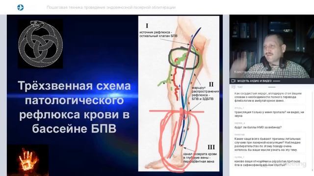 Пошаговая техника эндовенозной лазерной облитерации Вебинар для врачей