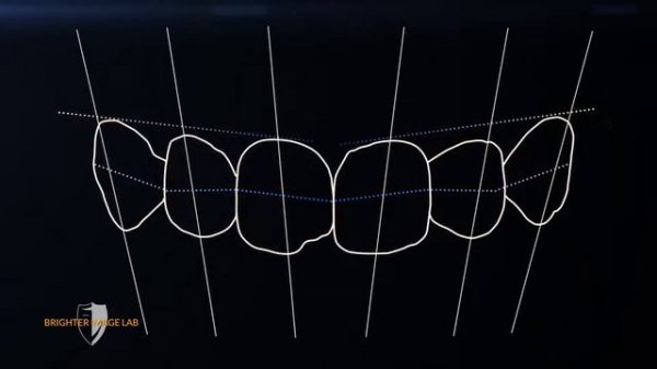 2017 Bilveneers $149 down for Chipped, Broken or Crooked Teeth from Brighter Image Lab