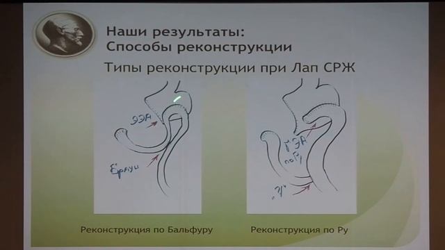 3 03 А М Карачун Малоинвазивная хирургия рака желудка смотреть онлайн