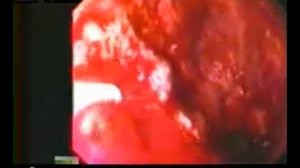 Метод АПК в остановке желудочно кишечных кровотечений