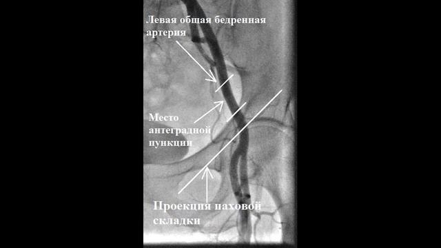 Пункция бедренной артерии (антеградный трансфеморальный доступ)