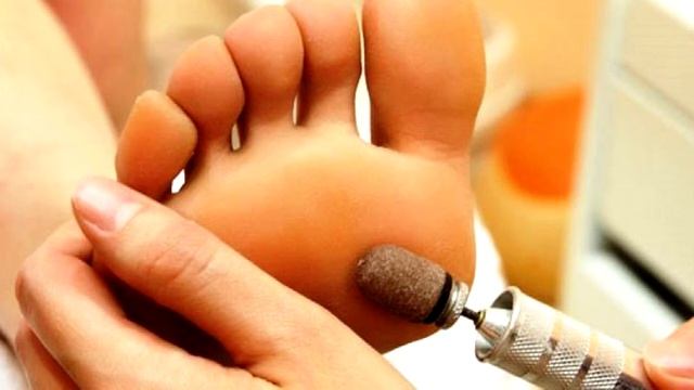 Как избавиться от сухих мозолей и натоптышей? смотреть онлайн