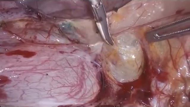 ICG right sentinel biopsy by Prof. N. Vlahos смотреть онлайн