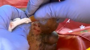 Jigger digging Jackson's left foot - watch this and 1000s others @riseupsociety.net