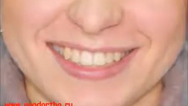 Брекеты ДО и ПОСЛЕ. Клиники GoodOrtho - мастерская вашей улыбки. смотреть онлайн