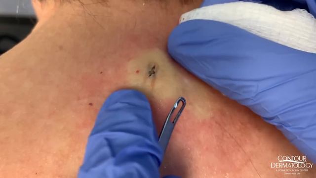 Blackhead (Jelly Bean) Extraction From Behind The Neck