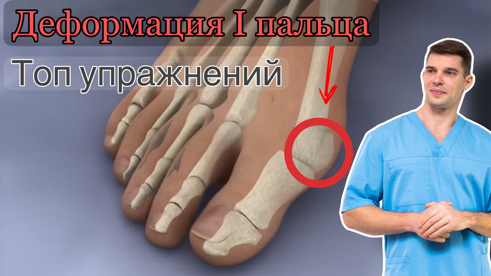 Лечения деформации первого пальца стопы Топ упражнений; «косточка» / халюс вальгус / стопы икры смотреть онлайн