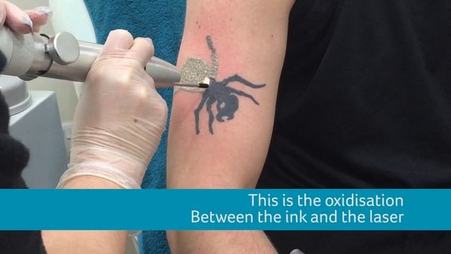 Prodigy Ant Tattoo Removal