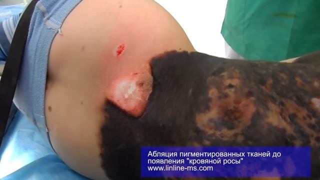 Лечение гигантского пигментного невуса смотреть онлайн