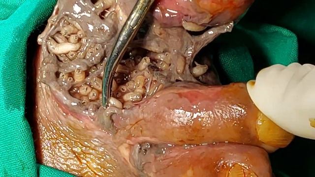 maggot infestation in a wound смотреть онлайн