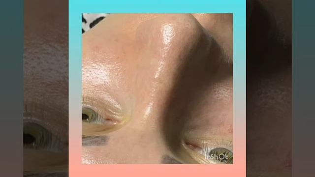 Чистка лица+азелаиновый пилинг