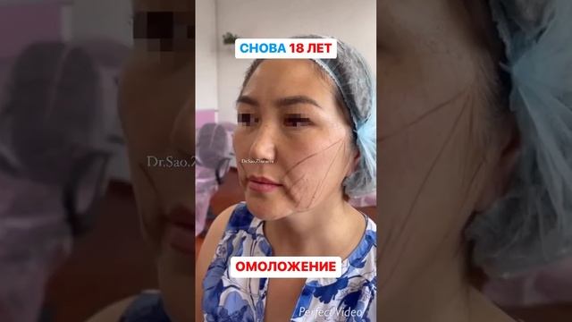 Лигатурный лифтинг смотреть онлайн
