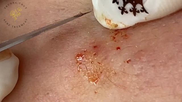 Acne Treament Under The Skin #035 смотреть онлайн