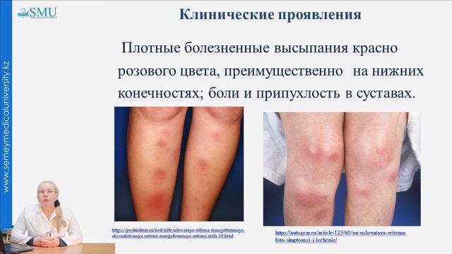 Узловатая эритема смотреть онлайн