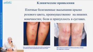 Узловатая эритема