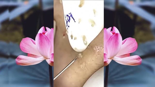 Выдавливание чёрных точек НОВОЕ! Удаление чёрных точек за ухом. p5 смотреть онлайн