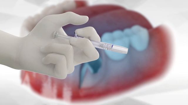 Bond Apatite® protocol for socket grafting with flap reflection смотреть онлайн
