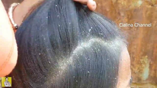 Dandruff Shampoo And Scratching, Itchy Dry Scalp, Huge Flake - Psoriasis #275