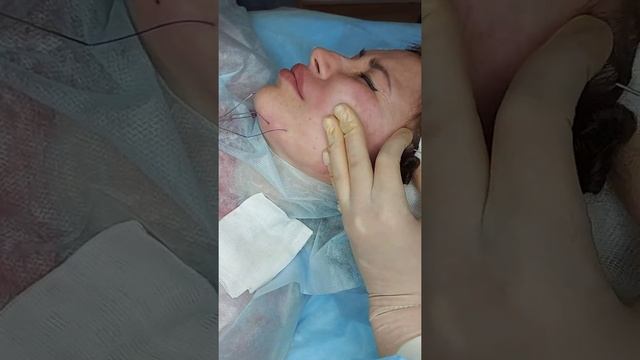 Коррекция нижней трети лица .Нити DUAL. смотреть онлайн