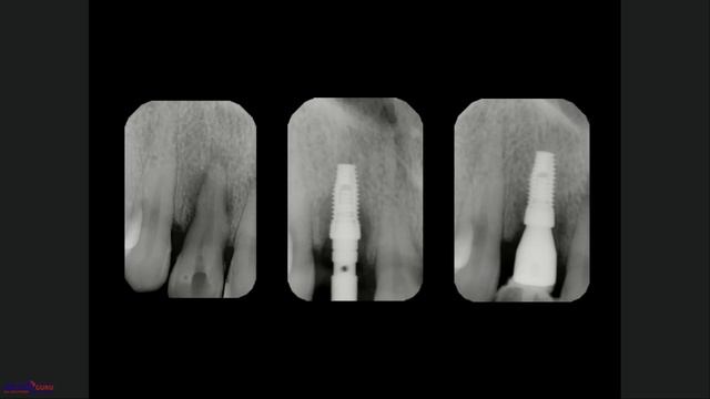 "Панцулая В.Г. Одномоментная имплантация и немедленная нагрузка"(18.06.2019) смотреть онлайн