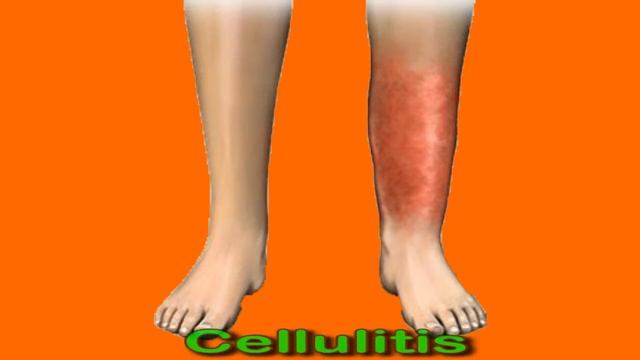 Swollen Lymph Nodes In The Armpit: Causes And Home Care смотреть онлайн