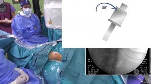 Техника чрескожной нефролитотомии наспине