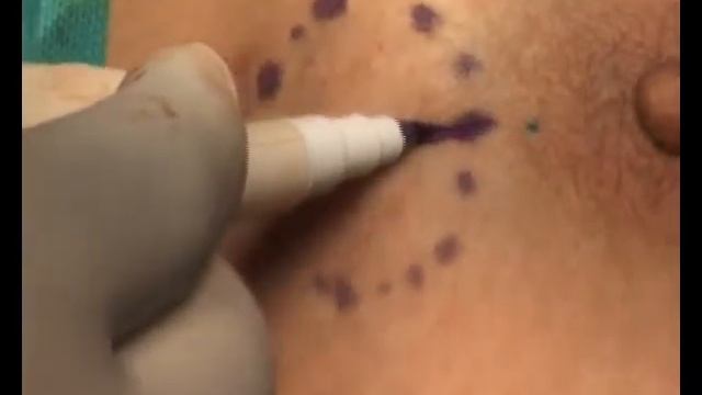 Breast Conservation Surgery with Sentinel Lymph Node Biopsy Axillary Disection смотреть онлайн