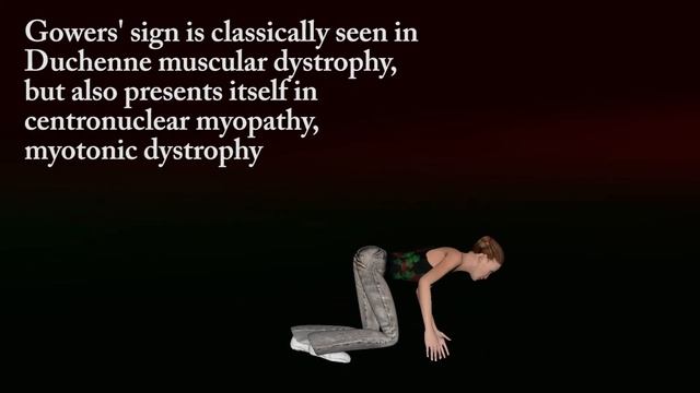 Gower s sign - gowers' maneuver _ Sign of proximal muscle weakness смотреть онлайн