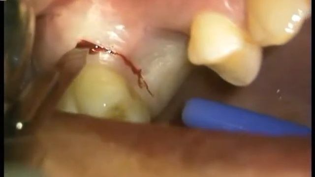 External Sinus Lift смотреть онлайн