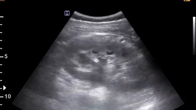 Каликопиелоэктазия