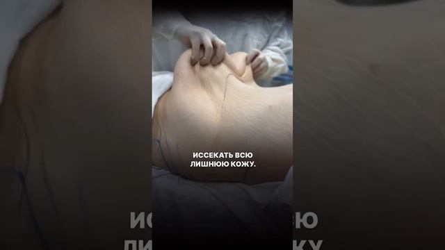 Видели как меняется фигура после бариатрии ?. Бодилифт. Пластический хирург- Муминат Ахмедовна смотреть онлайн