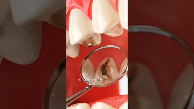 Как образуется кариес?