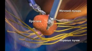 Роботизированная простатэктомия Да Винчи в Израиле