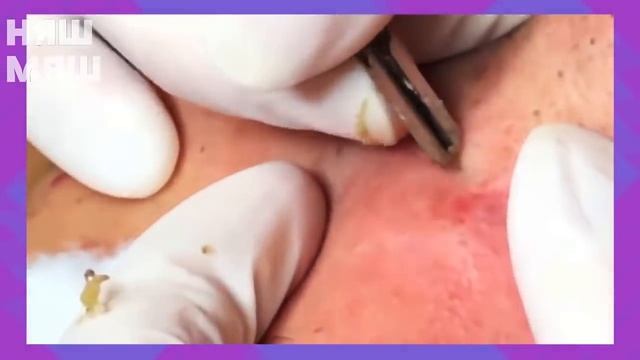 СЕМЕЙСТВО ПРЫЩЕЙ УГРЕЙ НА НОСУ ВЫДАВЛИВАЮ !!!как избавиться от прыщей !ЧЕРНЫЕ ТОЧКИ смотреть онлайн