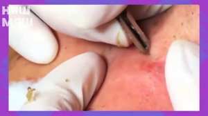 СЕМЕЙСТВО ПРЫЩЕЙ УГРЕЙ НА НОСУ ВЫДАВЛИВАЮ !!!как избавиться от прыщей !ЧЕРНЫЕ ТОЧКИ