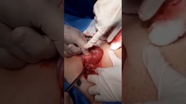 TRANSLOCATED IUD P2