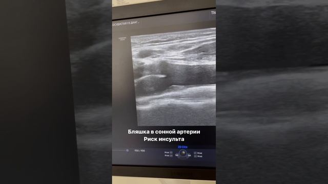 Атеросклероз. Высокий холестерин. Узи сонных артерий. Флеболог Москва. Флеболог. Сосудистый хирург смотреть онлайн