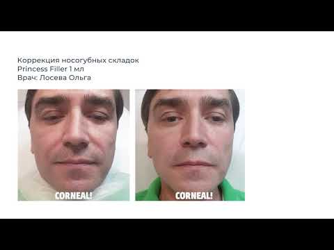 Новый вебинар в Corneal! Особенности работы с мужчинами. смотреть онлайн