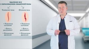 Лазерное лечение кисты копчика (эпителиальный копчиковый ход) ЭКХ