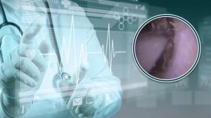 удаление ушной серы Удаление ушной серы Чистка ушной серы Огромная правая ушная сера при глухоте