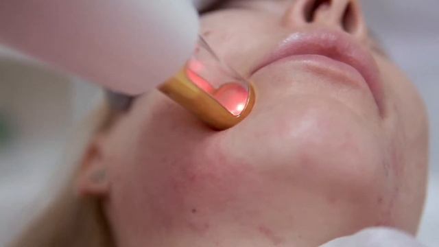 Лазерное омоложение лица на аппарате М22 смотреть онлайн