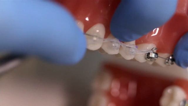 Что делать, если слетела резиночка с брекета? смотреть онлайн