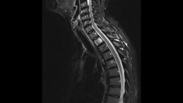 Typical and Atypical Hemangioma смотреть онлайн