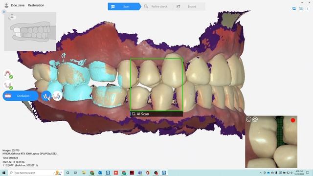 QUICKSCAN IOS 3D Intraoral Scanner by Runyes Software Demo смотреть онлайн