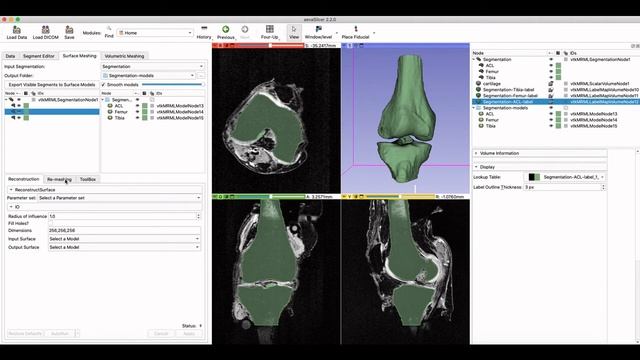 aeva: Femur-ACL-Tibia Tutorial смотреть онлайн