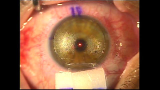 Femto - LASIK Procedure For The Correction Of Myopia With The Use Of Alcon Wavelight Suite