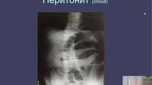 Лекция: Перитонит